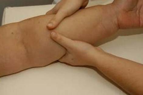 Linfedema Drenaje Linfatico Axilar Que Es Un Drenaje Linfatico